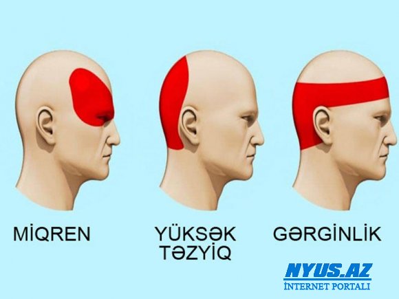 Başınız ağrıyırsa, dərman atmayın, bu çaylardan birini için