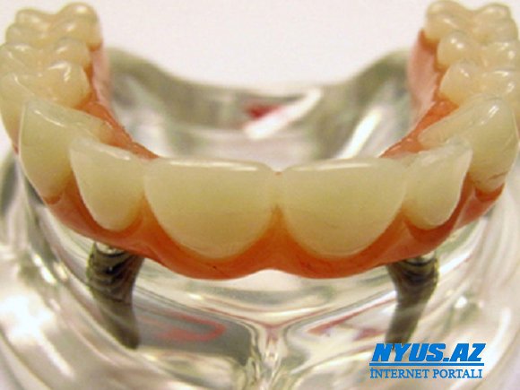 Diş implantları təhlükəli imiş - ALİMLƏRDƏN XƏBƏRDARLIQ