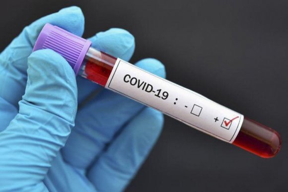Ermənistanda koronavirus şoku: son sutkada 571 nəfər