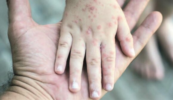 Gürcüstanda qızılcaya yoluxma kəskin artıb